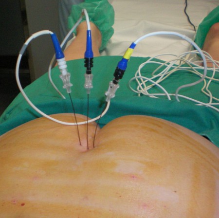 tratamiento de la coccigodinia